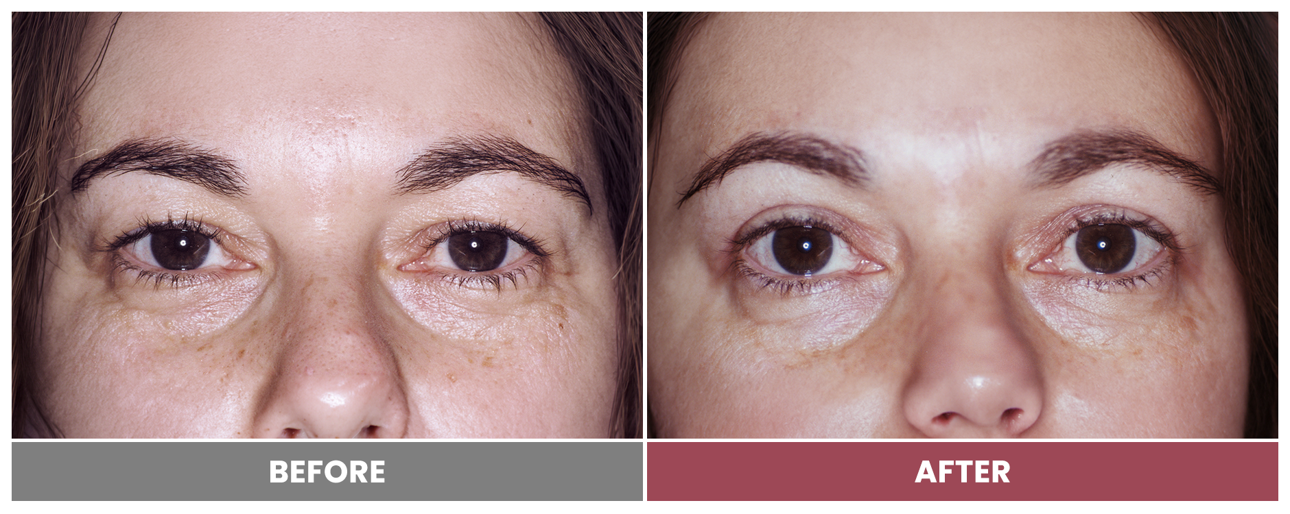 Upper Blepharoplasty - Case 21